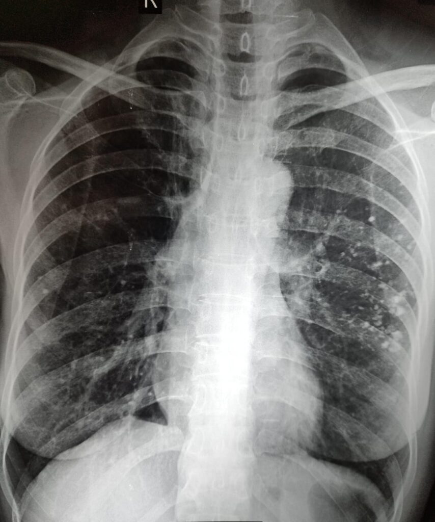 post tuberculosis calcification. dr sanjoy kumar ray